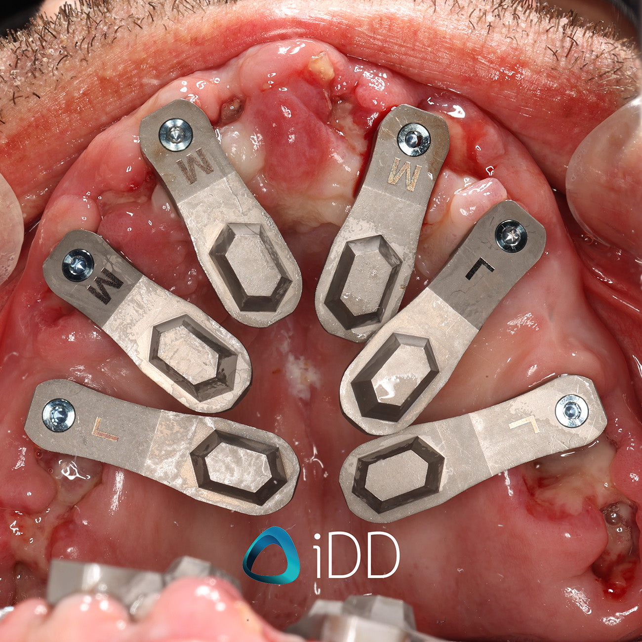TruAbutment ioConnect