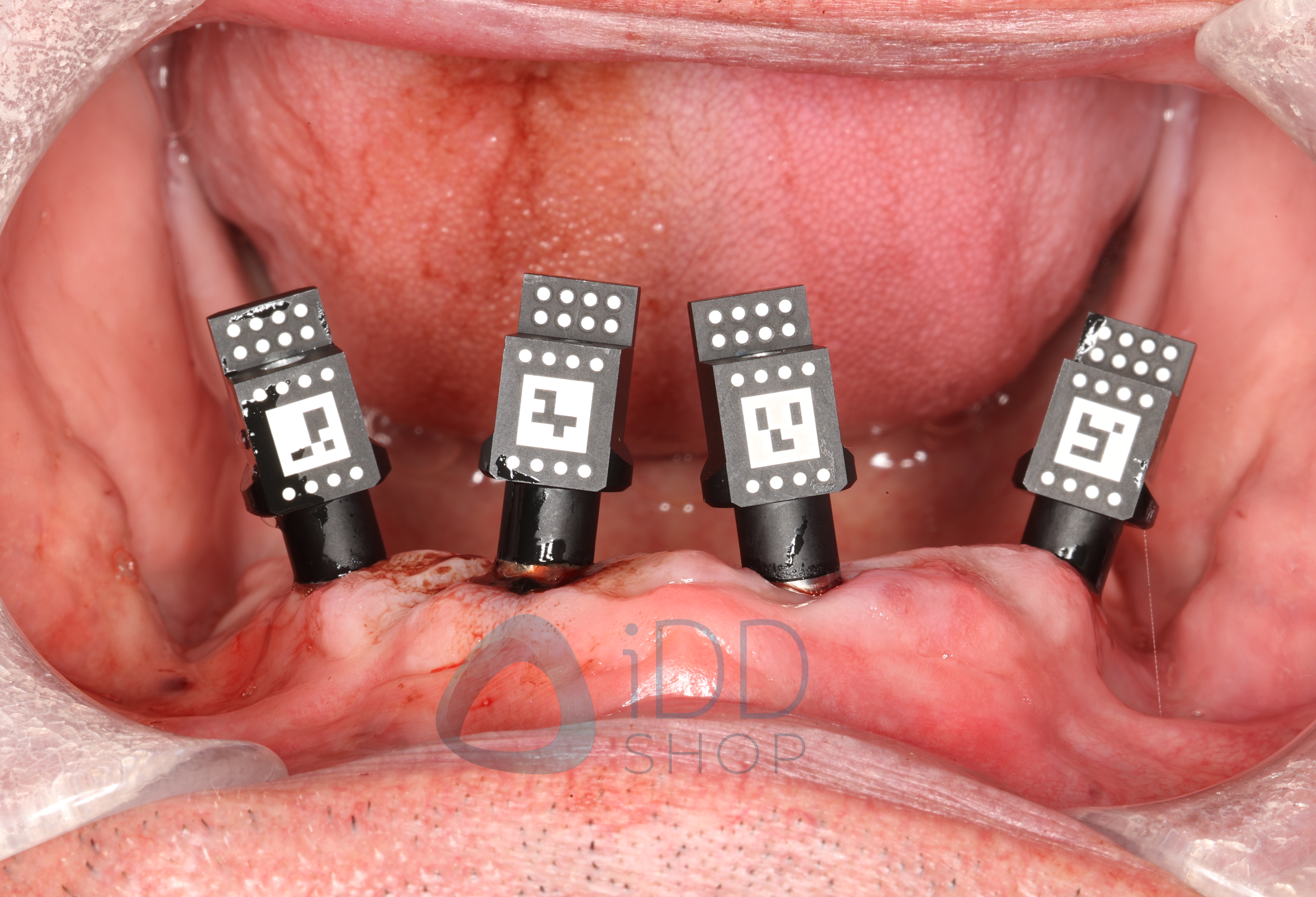 TruAbutment T-Marker
