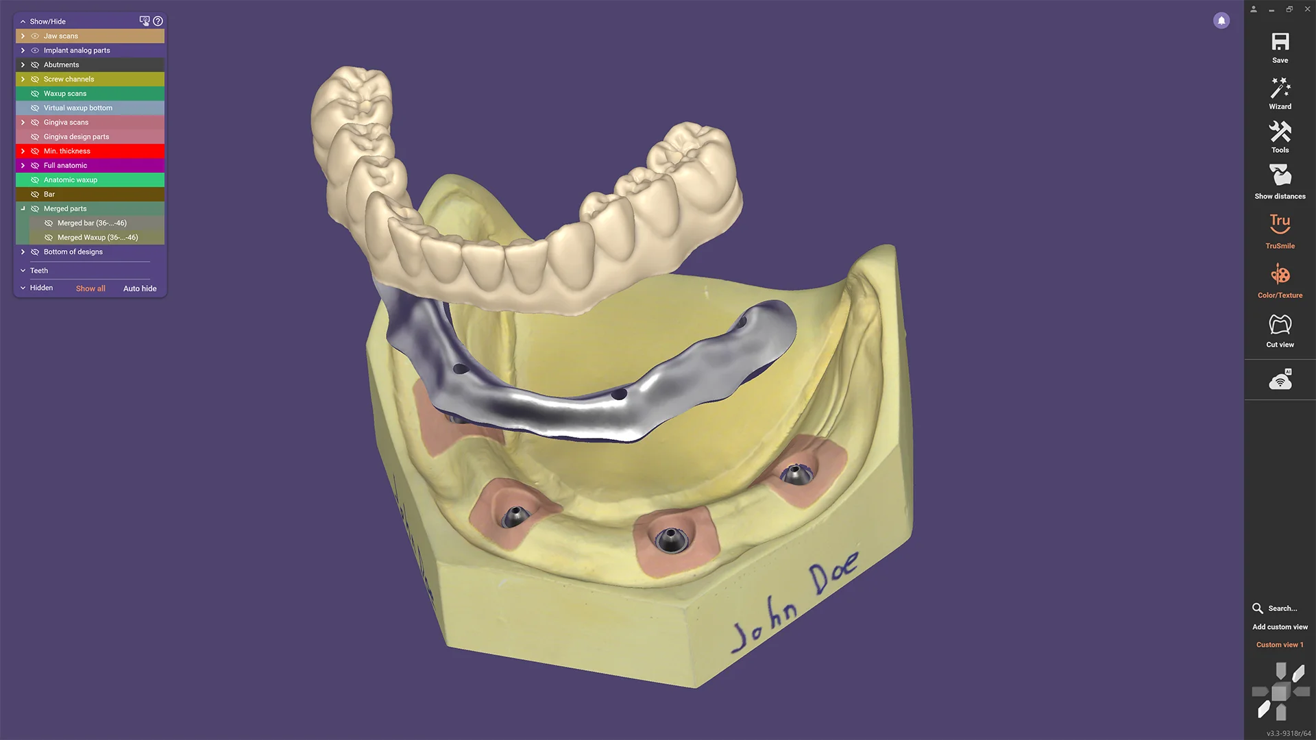 Exocad - DentalCAD Software