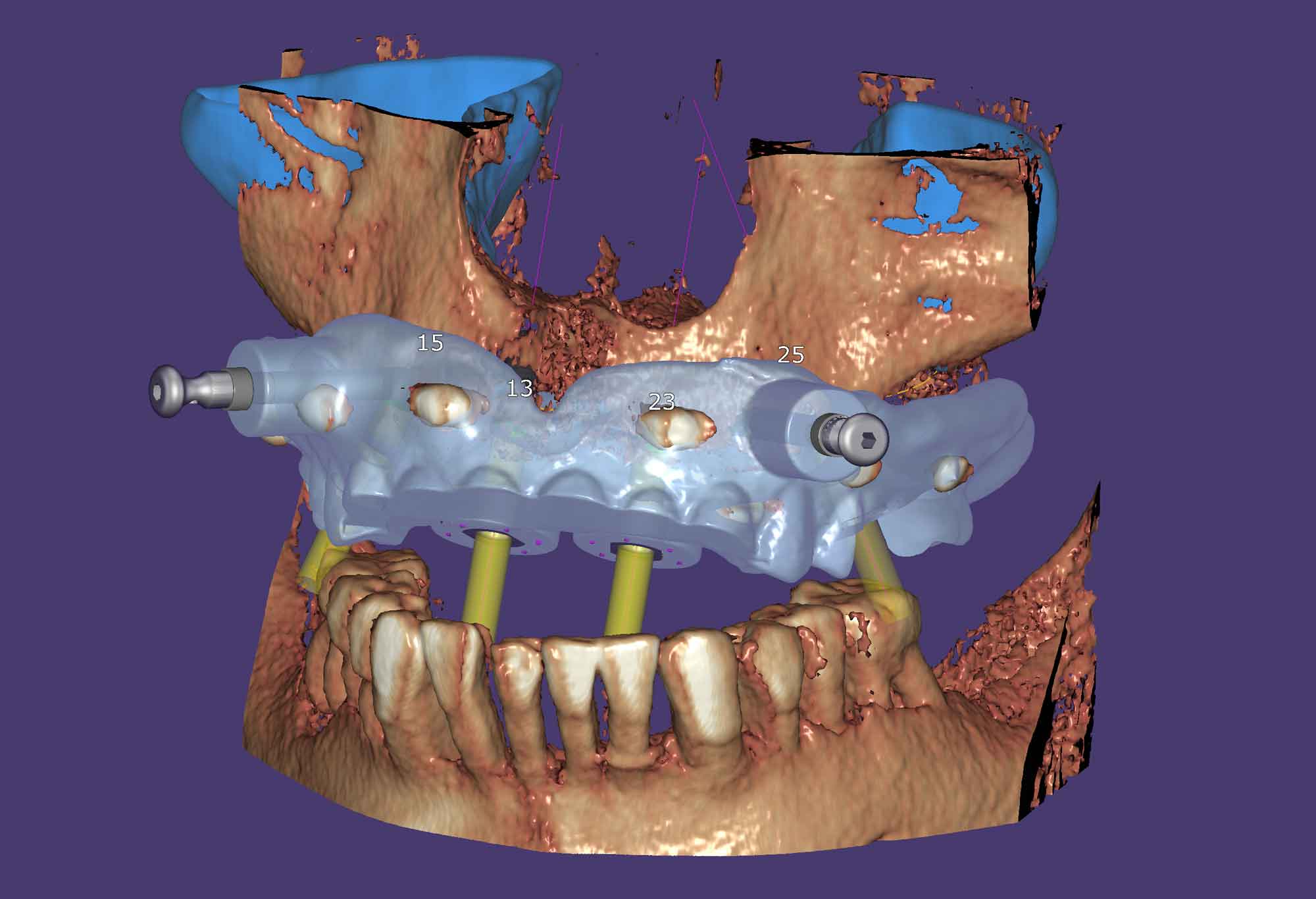 Exoplan - Implant Guide Software