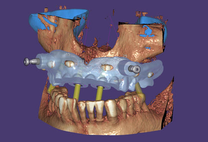 Exoplan - Implant Guide Software