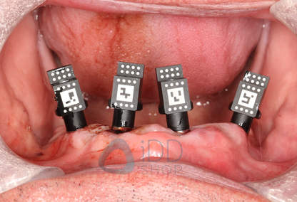 TruAbutment T-Marker
