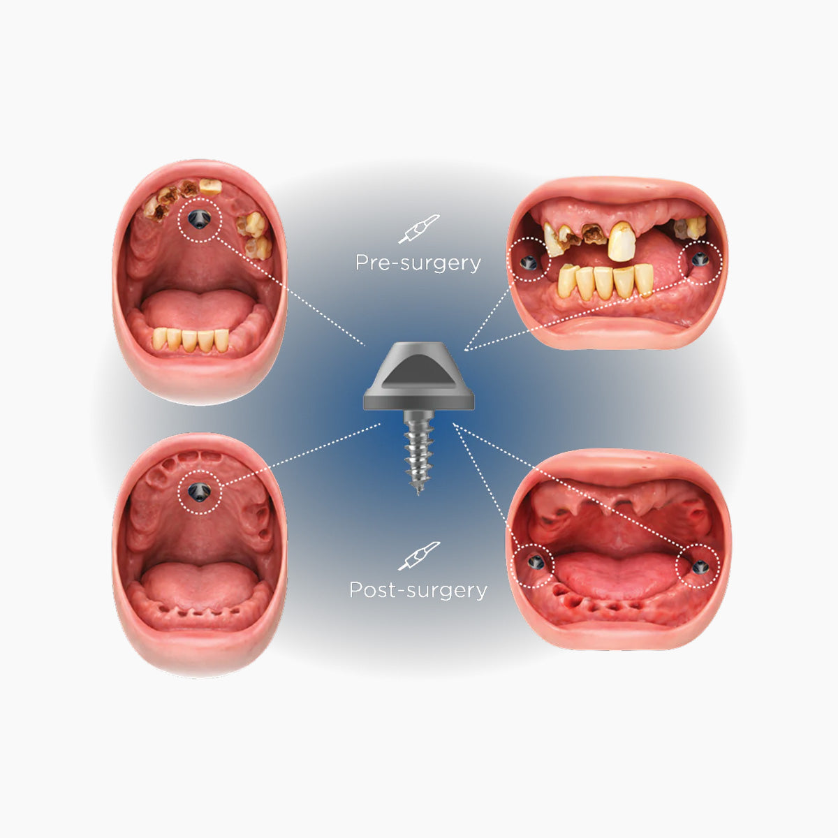 TruAbutment Tru-Bolt Kit Fiducial Marker