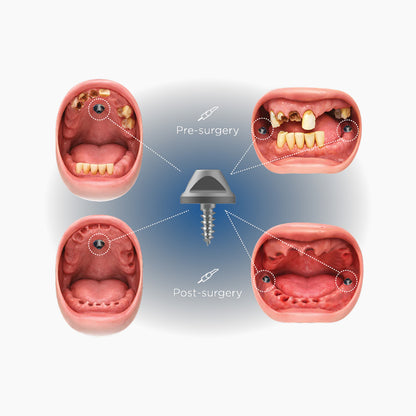 TruAbutment Tru-Bolt Kit Fiducial Marker